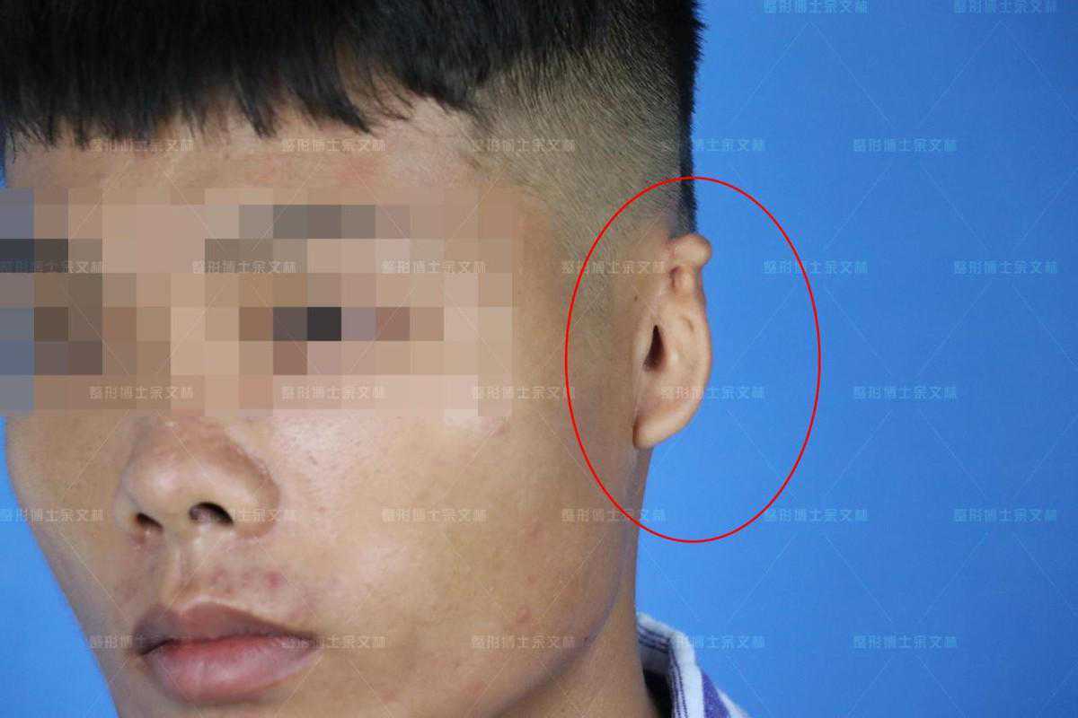 「案例分析」直埋法做完后效果怎么样？来看一组完整案例